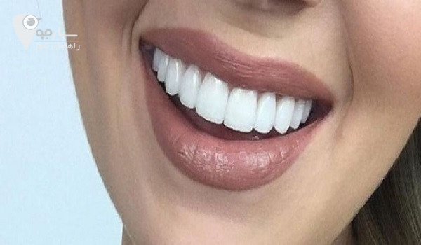 فیسینگ دندان در شیراز | بهترین دکتر لمینت دندان در شیراز
