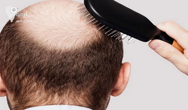 درمان ریزش مو ارثی و درمان ریزش مو مردان با استفاده از روش های خانگی تاثیر کمی دارد.