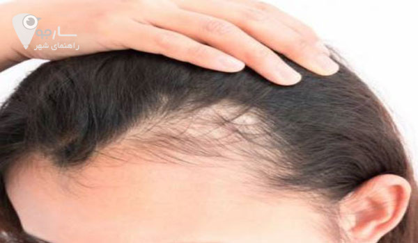 درمان ریزش مو زنان بهتر است توسط پزشک انجام شود . 